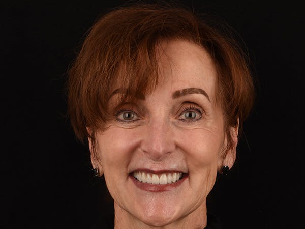 Porcelain Veneers Before & After Gallery - Patient 140400254 - Image 3