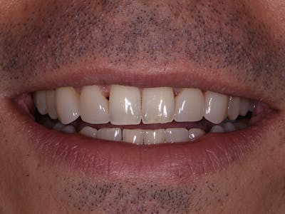 Porcelain Veneers Before & After Gallery - Patient 140400253 - Image 1