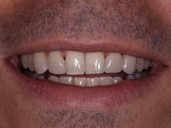 Porcelain Veneers Before & After Gallery - Patient 140400253 - Image 1