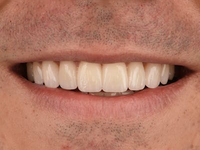 Porcelain Veneers Before & After Gallery - Patient 140400253 - Image 2