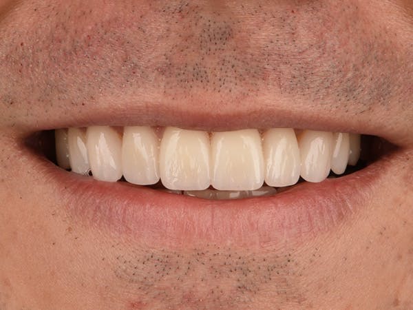 Porcelain Veneers Before & After Gallery - Patient 140400253 - Image 2