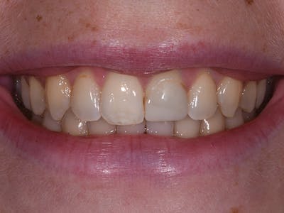 Teeth Whitening Before & After Gallery - Patient 140400296 - Image 1