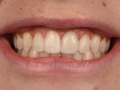 Teeth Whitening Before & After Gallery - Patient 140400296 - Image 2