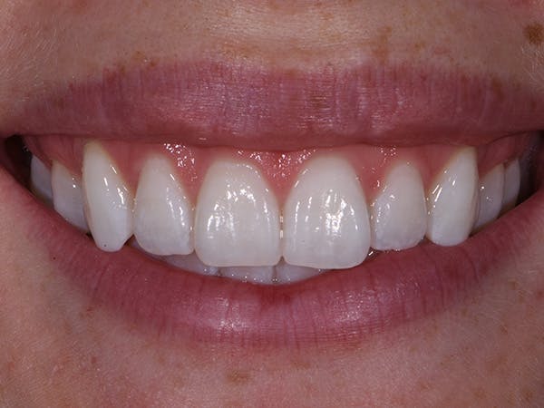 Teeth Whitening Before & After Gallery - Patient 140400297 - Image 2