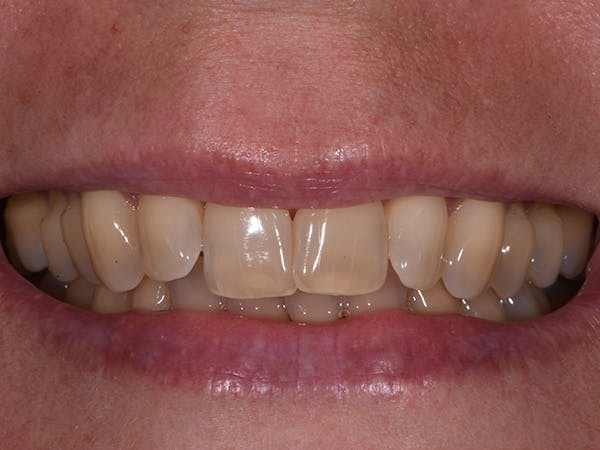 Teeth Whitening Before & After Gallery - Patient 140400298 - Image 1