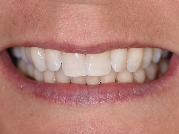 Teeth Whitening Before & After Gallery - Patient 140400298 - Image 2
