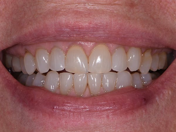 Teeth Whitening Before & After Gallery - Patient 140400299 - Image 1