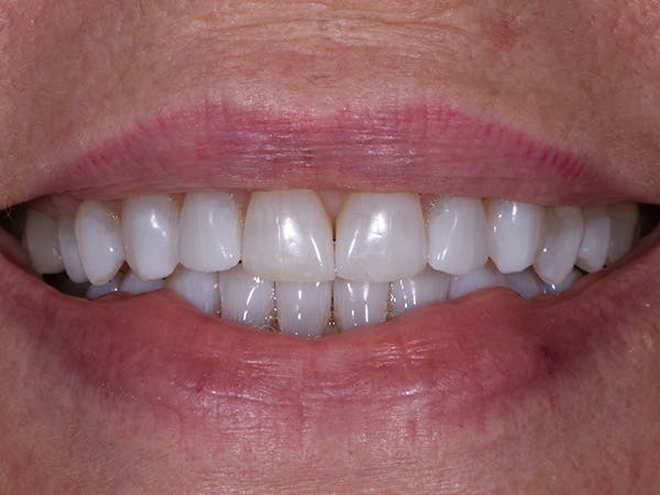 Teeth Whitening Before & After Gallery - Patient 140400299 - Image 2