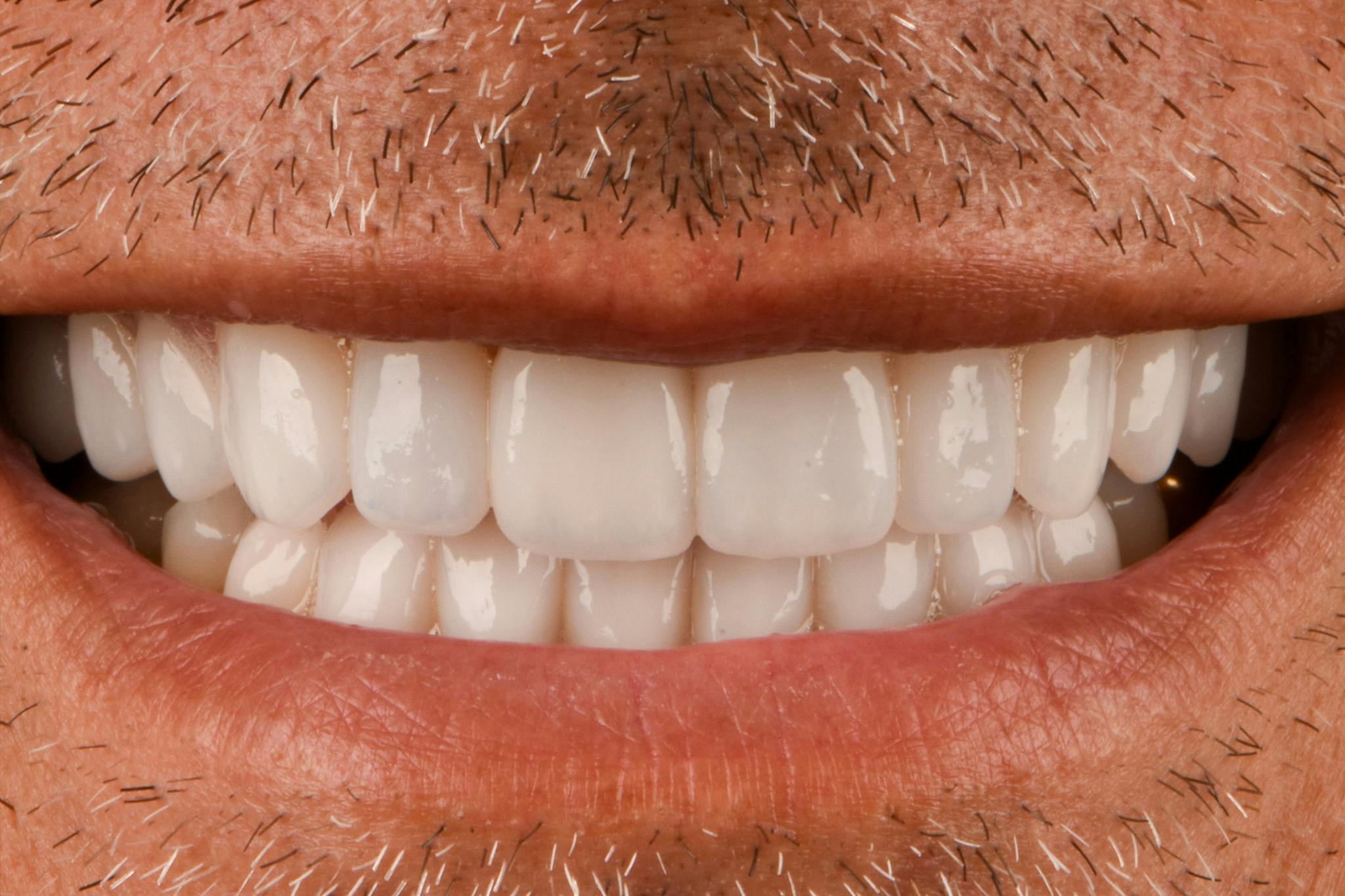 Full Mouth Reconstruction Before & After Gallery - Patient 3013897 - Image 2