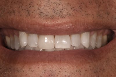 Full Mouth Reconstruction Before & After Gallery - Patient 3013897 - Image 1