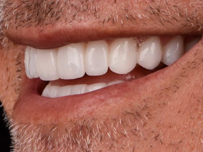 Teeth photo