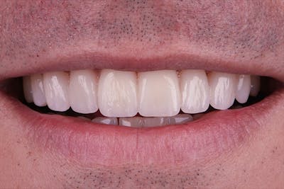 Teeth photo