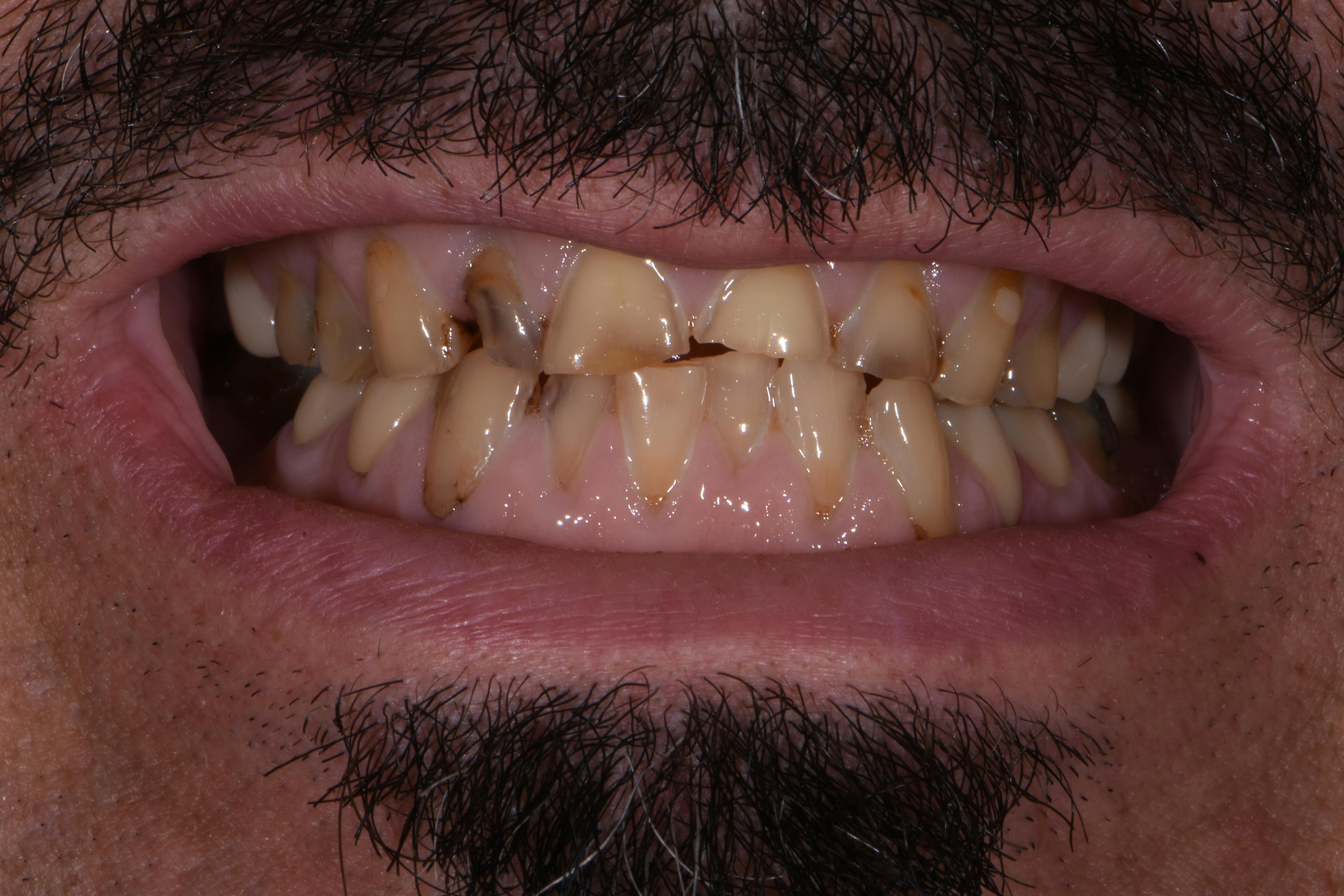 Porcelain Crowns Before & After Gallery - Patient 680851 - Image 1