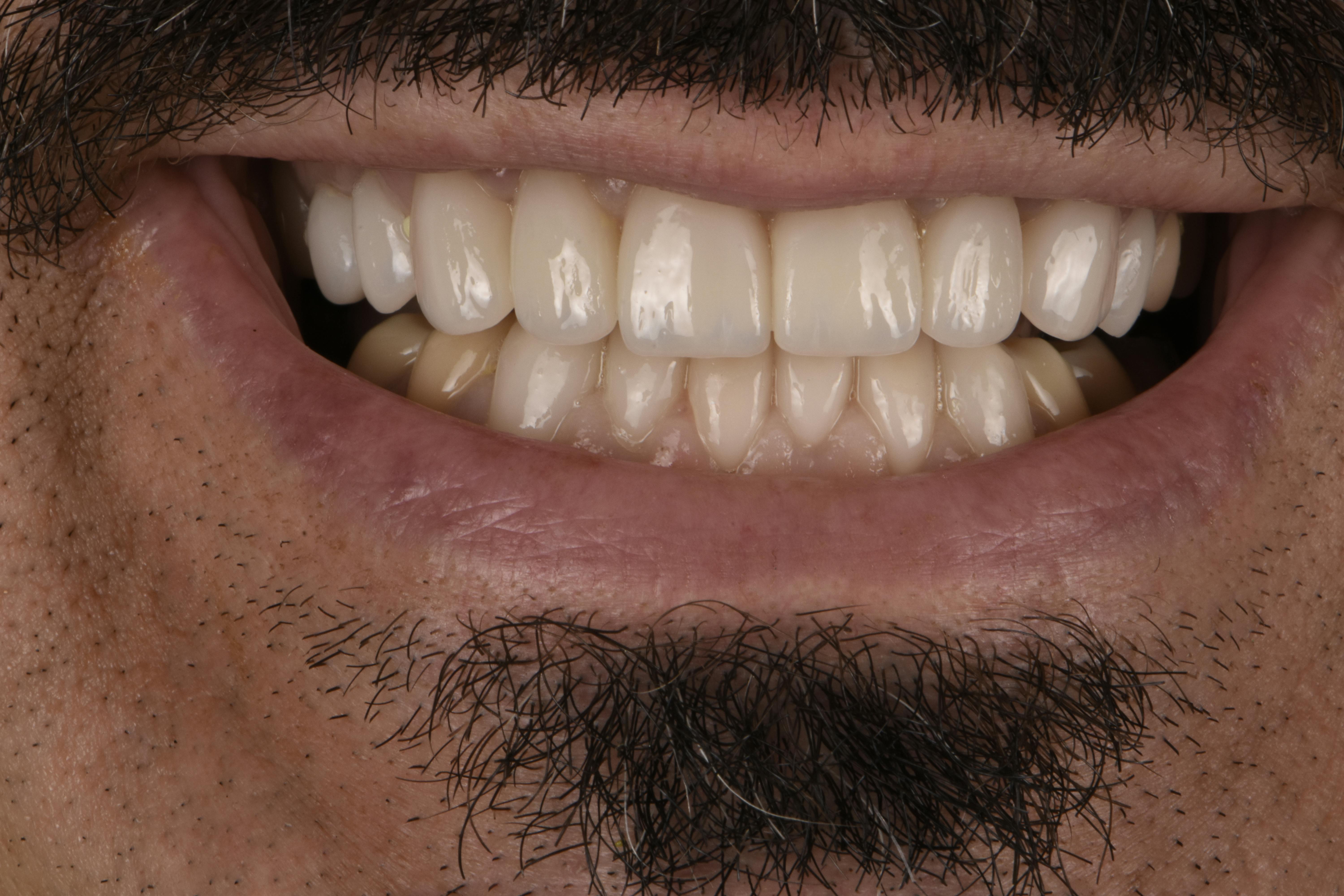 Porcelain Crowns Before & After Gallery - Patient 680851 - Image 2