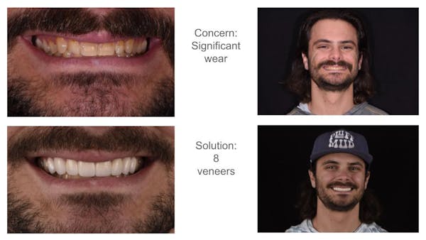 Porcelain Veneers Before & After Gallery - Patient 398942 - Image 5