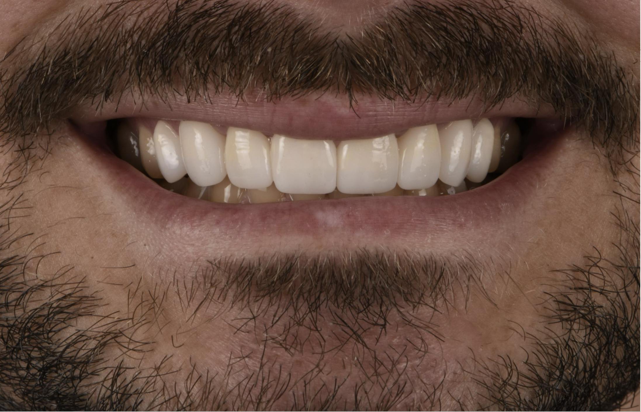 Porcelain Veneers Before & After Gallery - Patient 398942 - Image 2