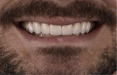 Porcelain Veneers Before & After Gallery - Patient 398942 - Image 2
