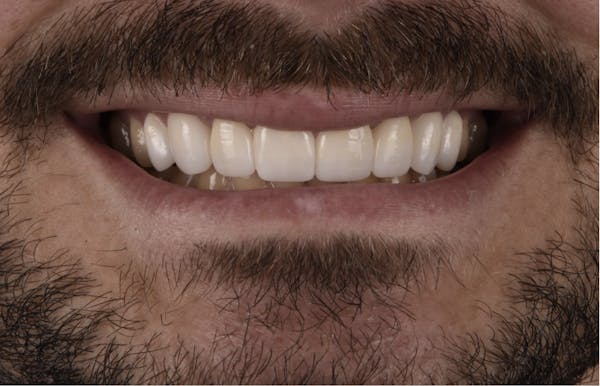 Porcelain Veneers Before & After Gallery - Patient 398942 - Image 2