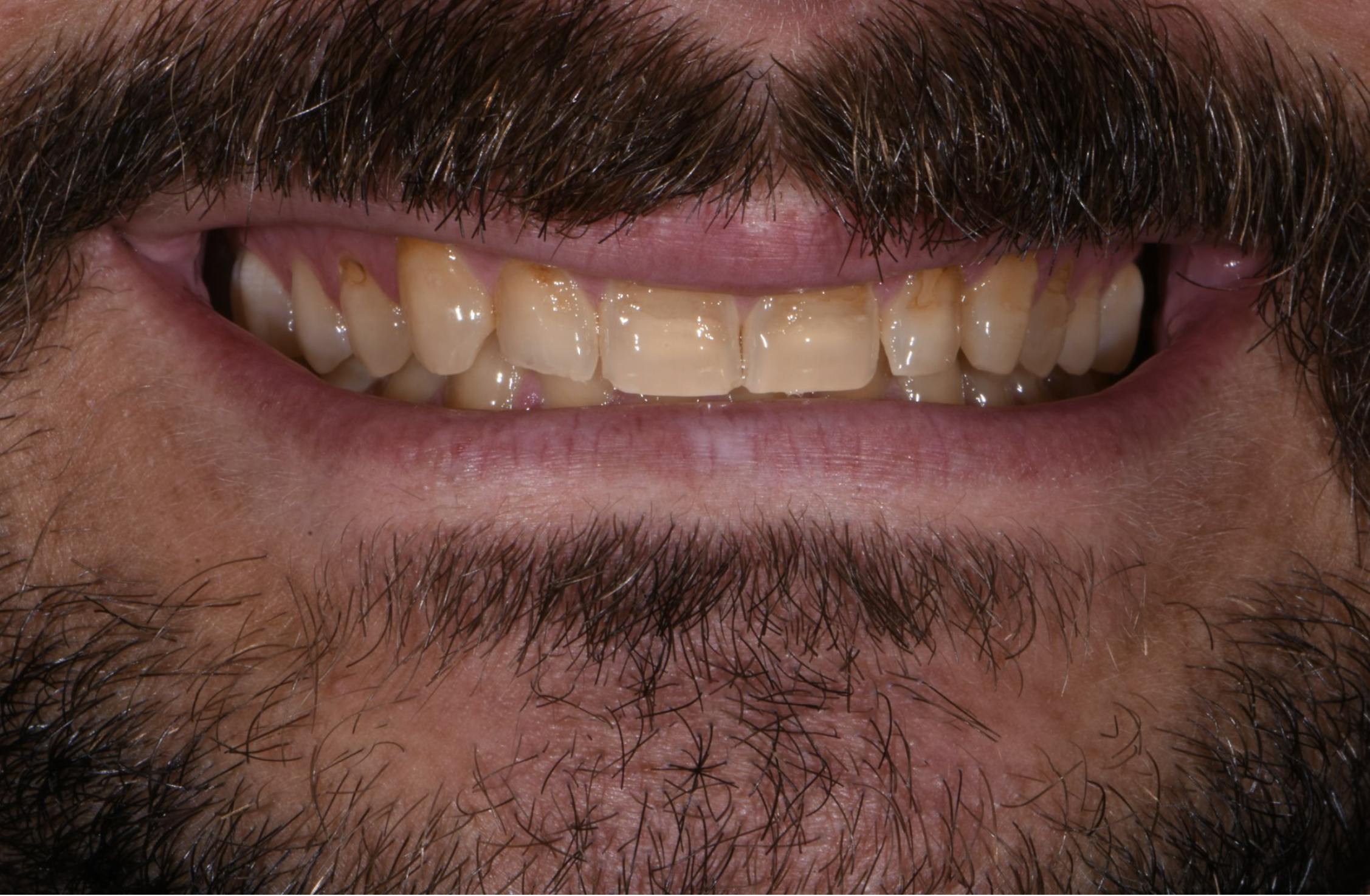Porcelain Veneers Before & After Gallery - Patient 398942 - Image 1