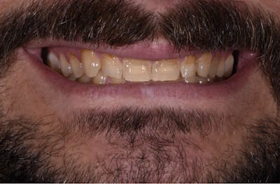 Porcelain Veneers Before & After Gallery - Patient 398942 - Image 1