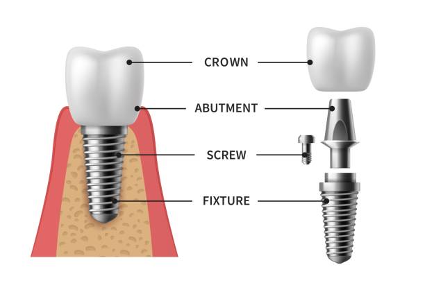 Infographic of the Components of a Dental Implant