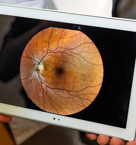ocular image