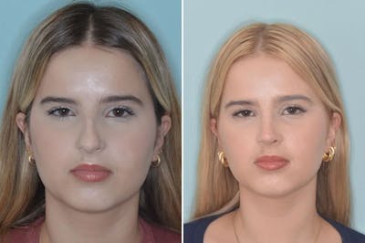 Ethnic Rhinoplasty before and after, frontal.