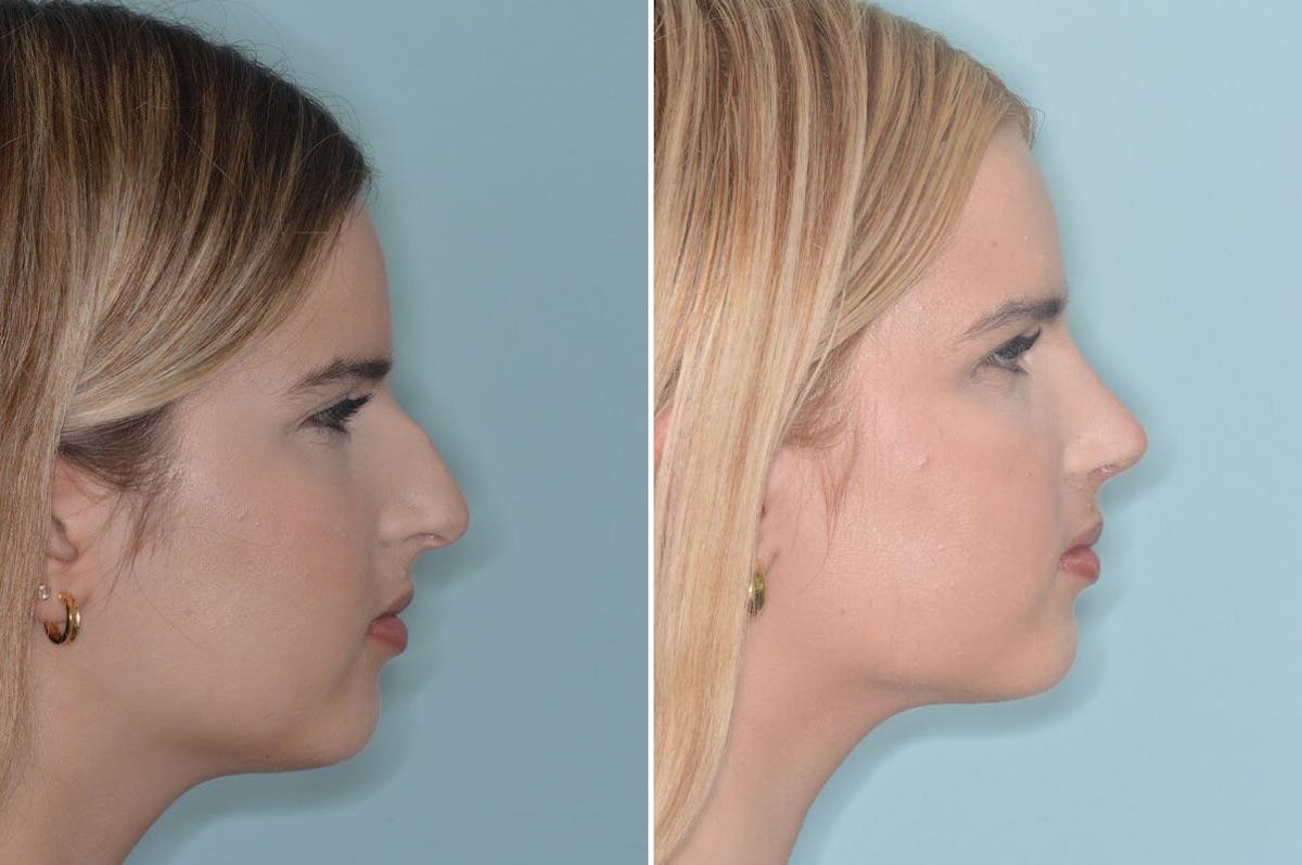 Ethnic Rhinoplasty before and after, lateral right.