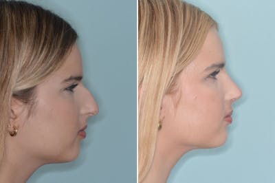 Ethnic Rhinoplasty before and after, lateral right.