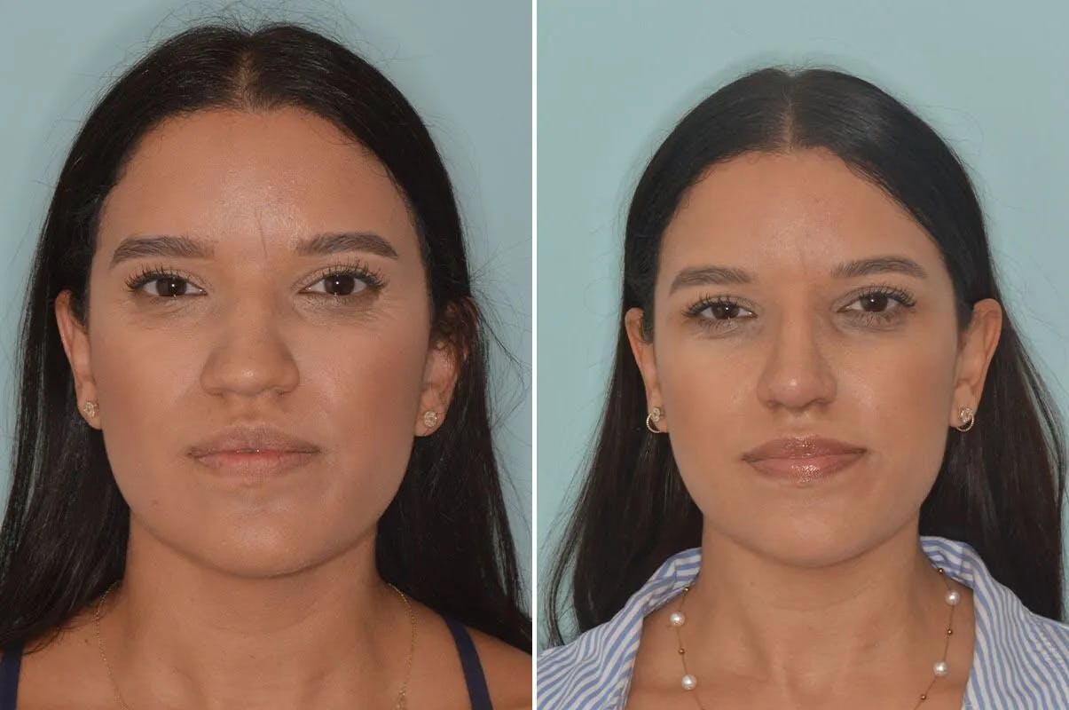 Ethnic Rhinoplasty before and after, frontal.
