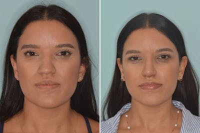 Ethnic Rhinoplasty before and after, frontal.