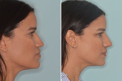 Ethnic Rhinoplasty before and after, lateral right.