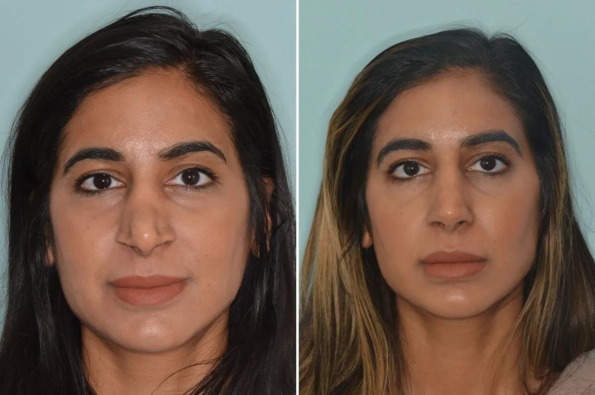 Rhinoplasty before and after, frontal.
