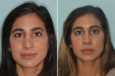 Rhinoplasty before and after, frontal.