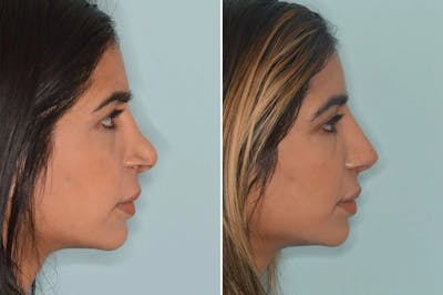 Rhinoplasty before and after, lateral right.