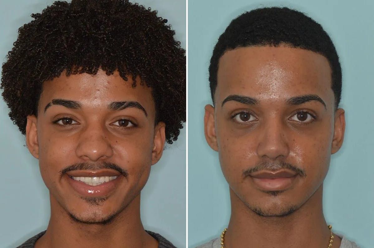 Ethnic Rhinoplasty before and after, frontal.