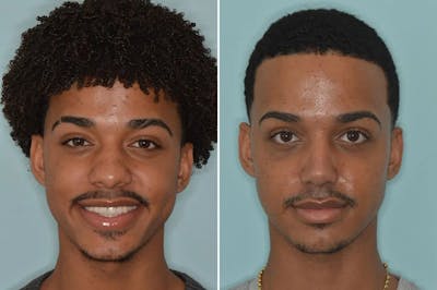 Ethnic Rhinoplasty before and after, frontal.