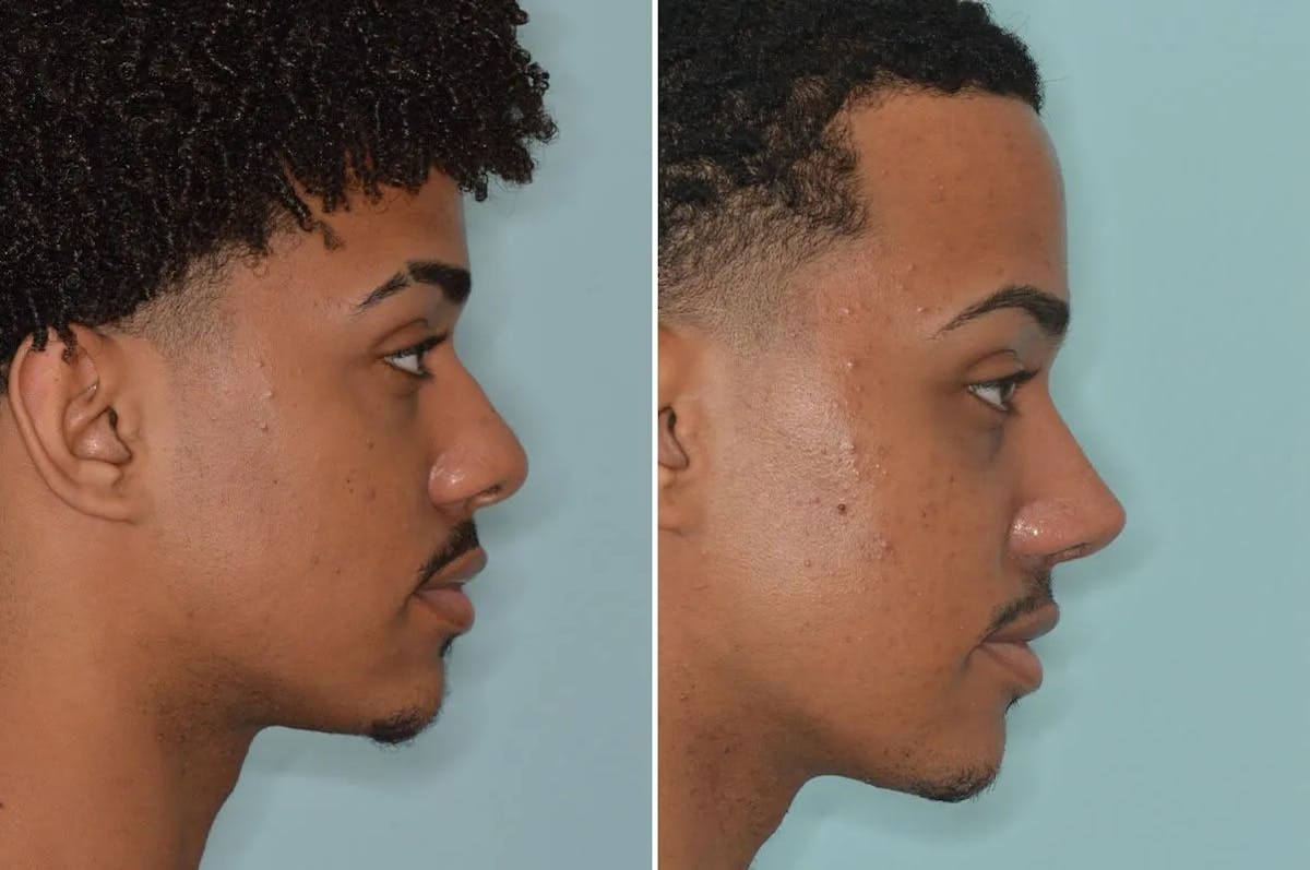 Ethnic Rhinoplasty before and after, frontal.