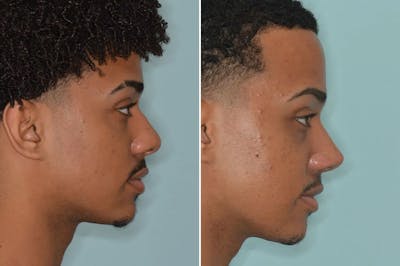 Ethnic Rhinoplasty before and after, frontal.
