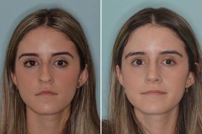 Ethnic Rhinoplasty before and after, frontal.
