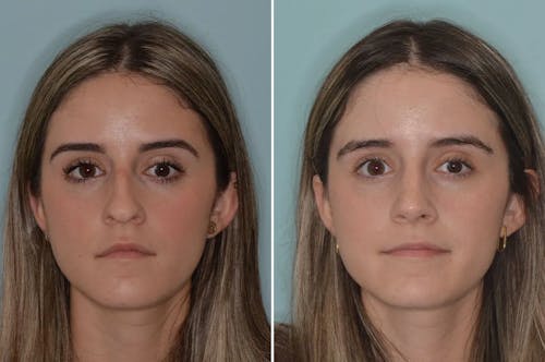 Ethnic Rhinoplasty before and after, frontal.
