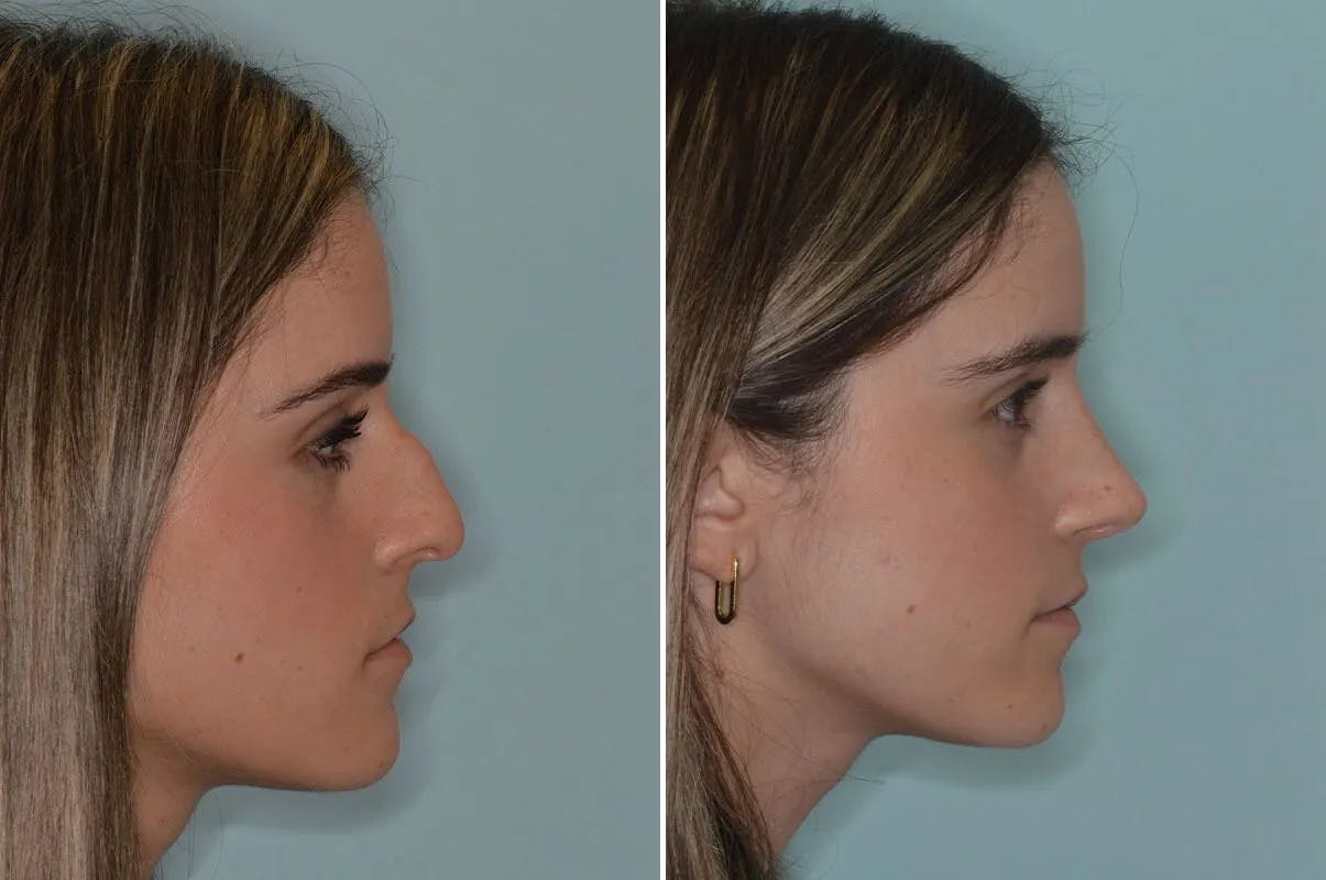 Ethnic Rhinoplasty before and after, lateral right.