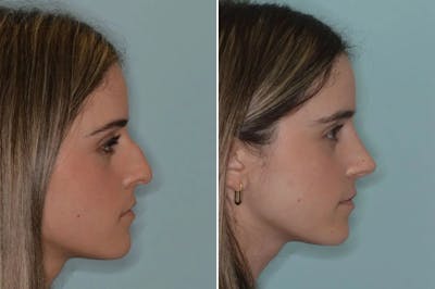 Ethnic Rhinoplasty before and after, lateral right.