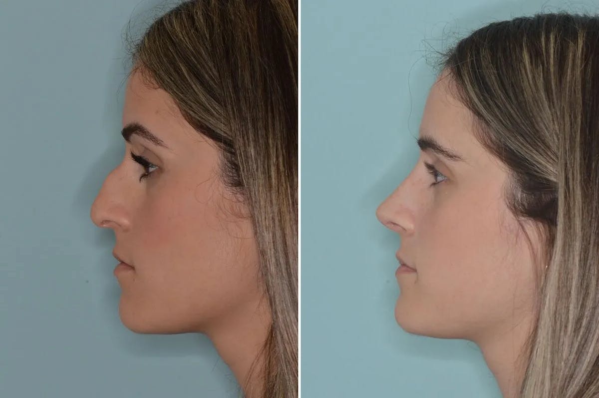Ethnic Rhinoplasty before and after, lateral left.