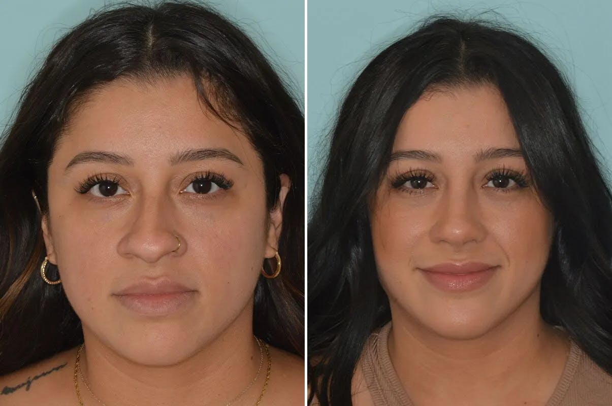 Ethnic Rhinoplasty before and after, frontal.