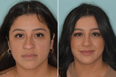 Ethnic Rhinoplasty before and after, frontal.