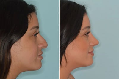 Ethnic Rhinoplasty before and after, lateral right.