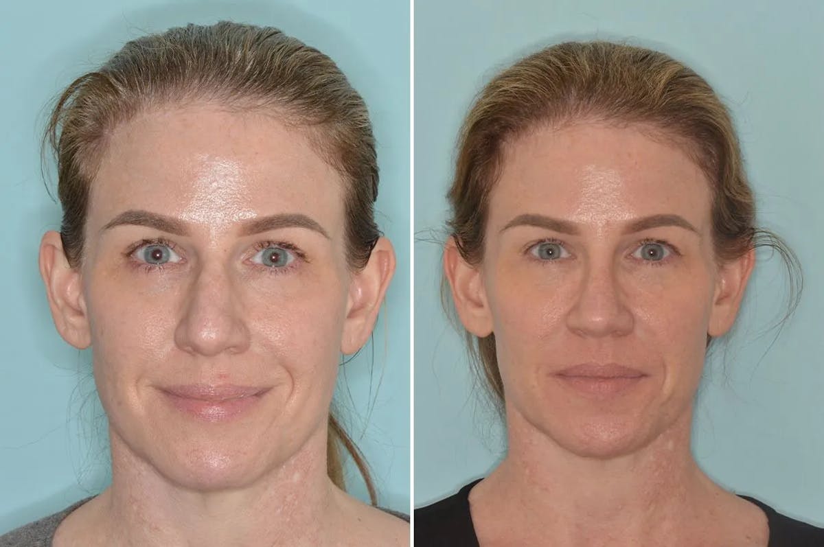 Rhinoplasty before and after, frontal.