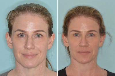 Rhinoplasty before and after, frontal.