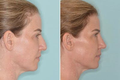 Rhinoplasty before and after, lateral right.
